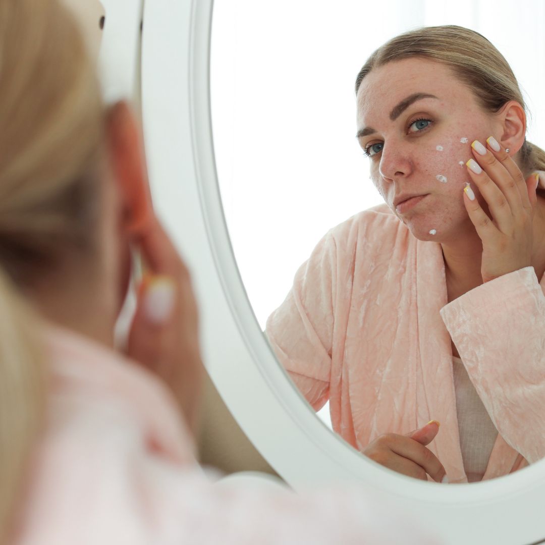 Woman managing acne and skin health with PCOS PMOS